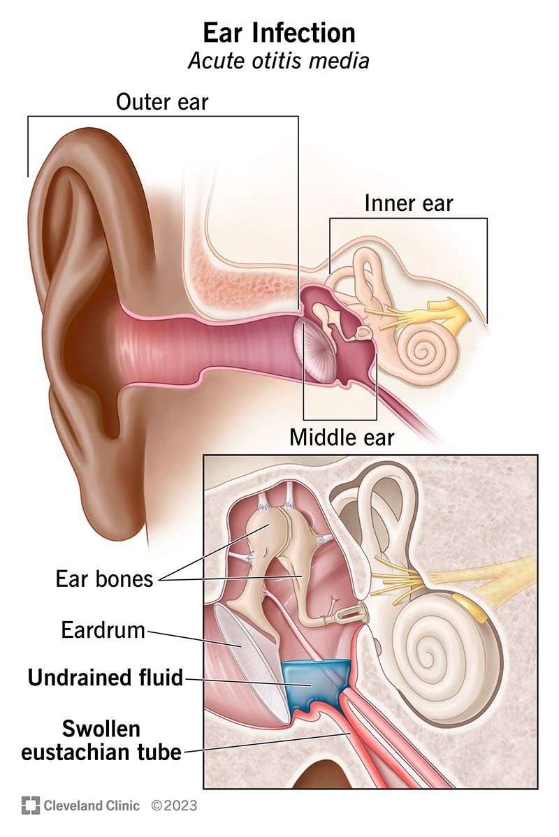 Causes and Triggers of Ear Problems