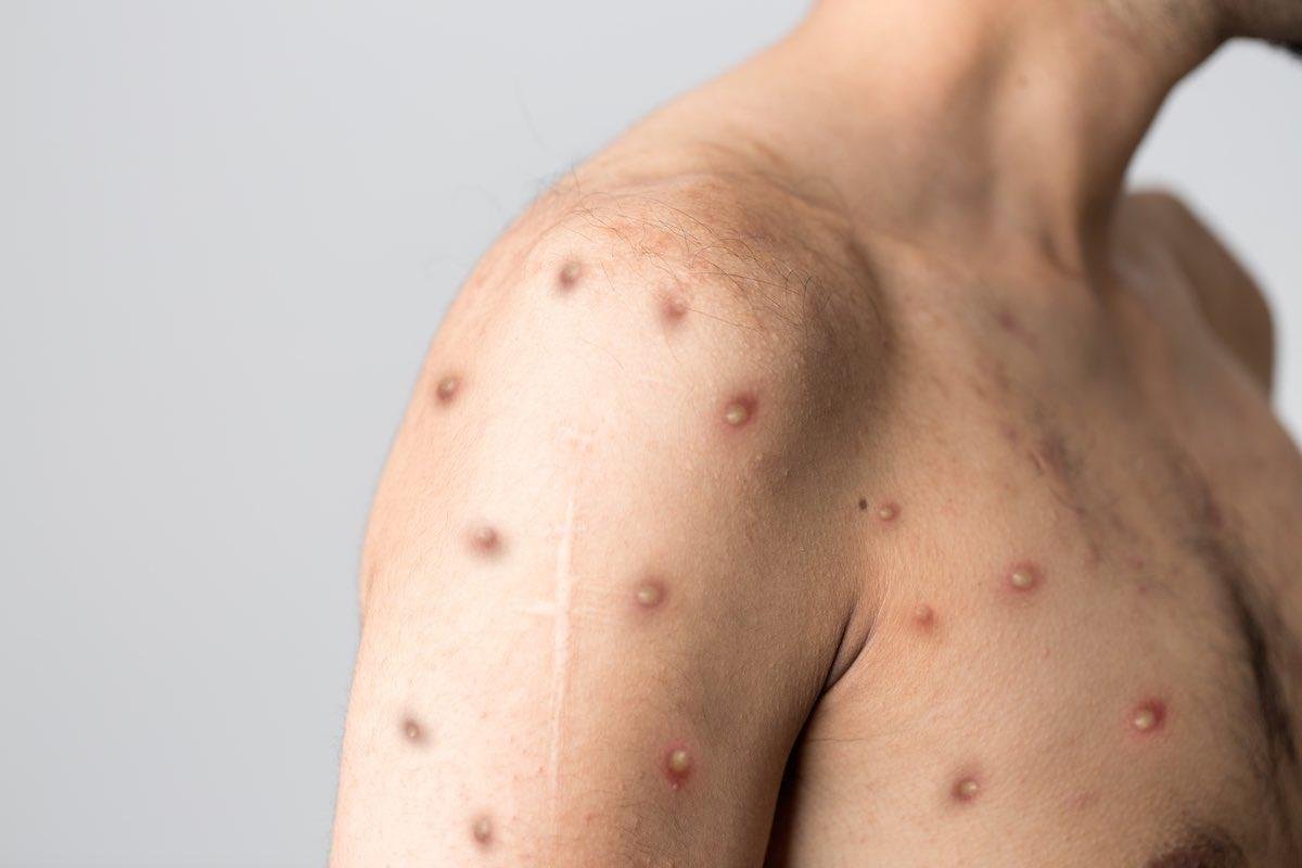 Other Symptoms to Watch For