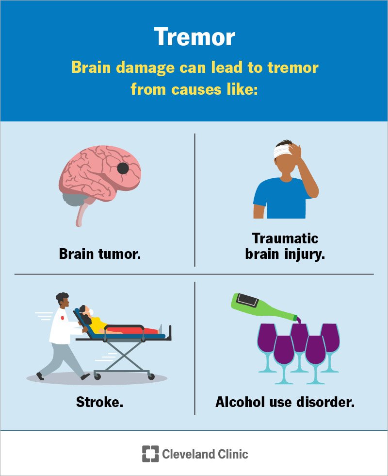 Head tremors vs normal head shaking