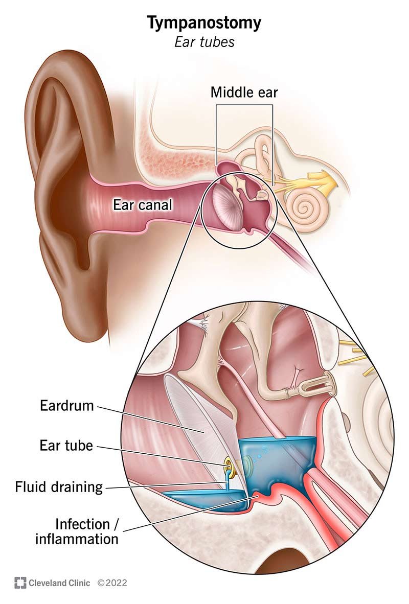 Preventing Future Ear Discharge