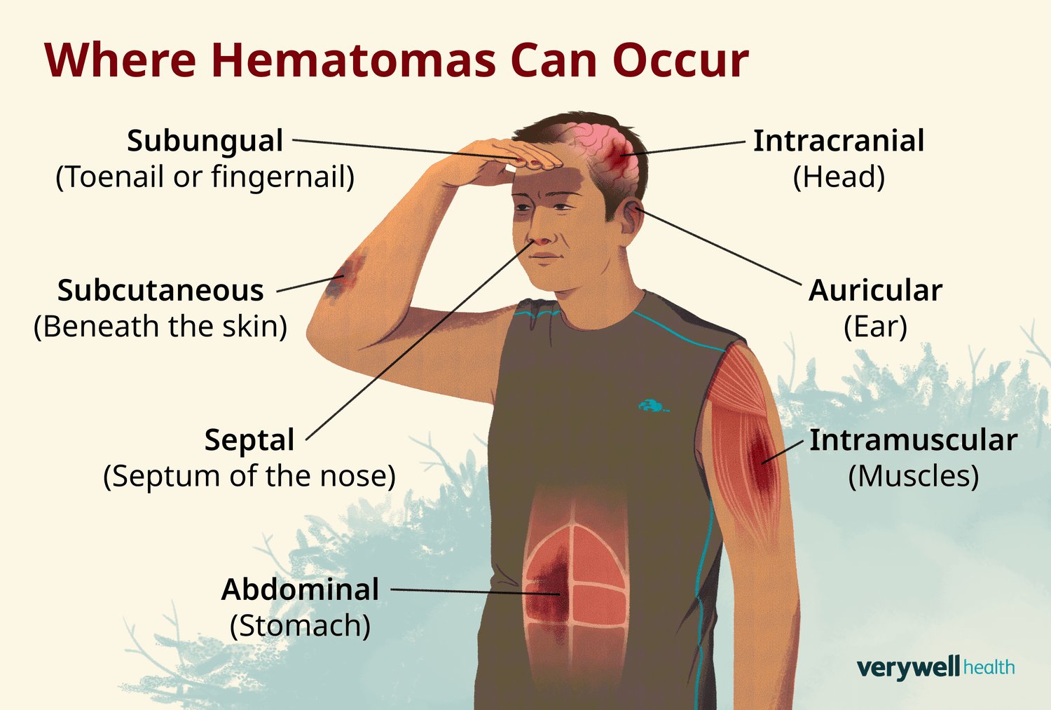 Preventing Future Ear Hematomas