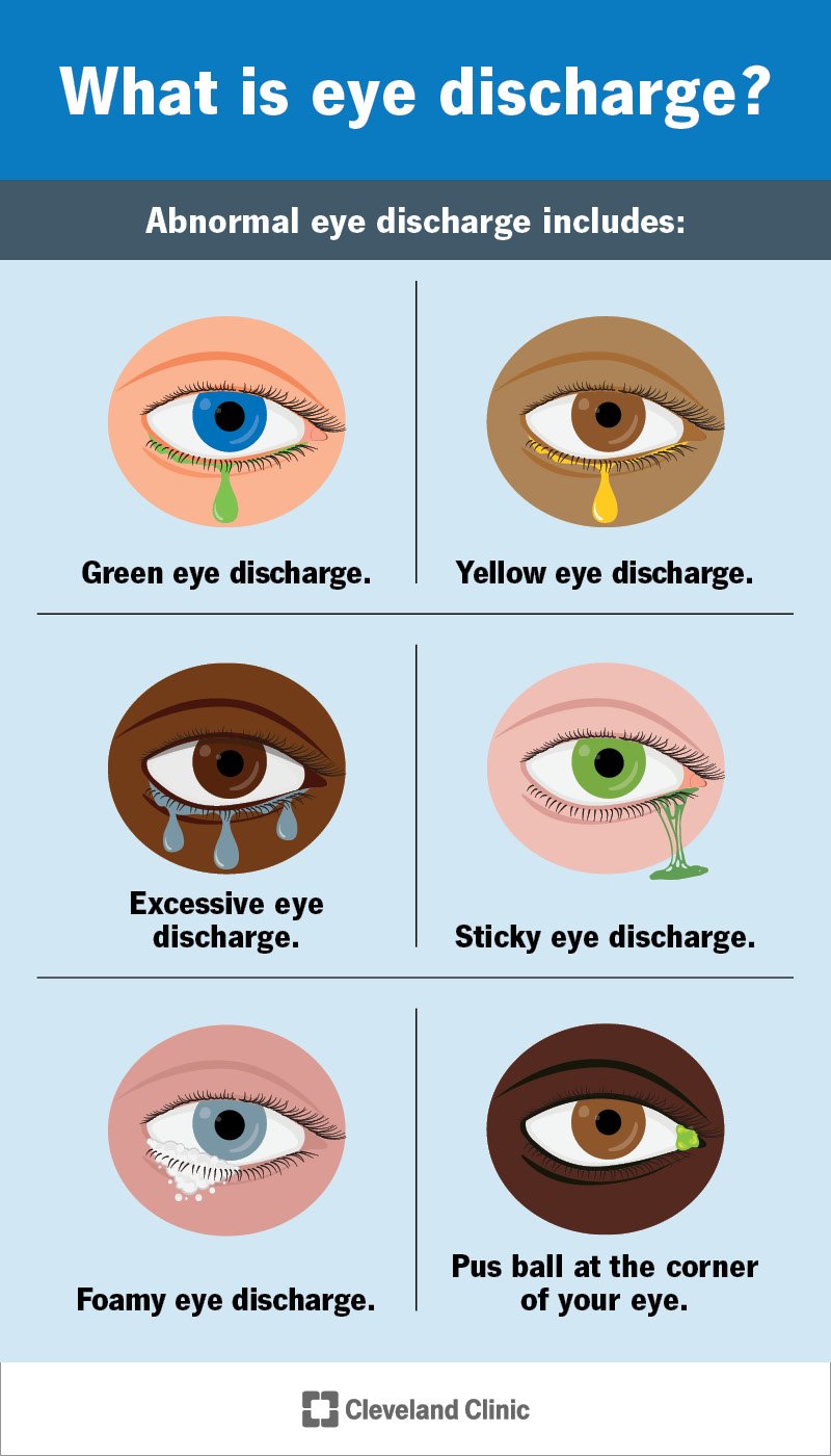 What Eye Discharge Color Can Tell You